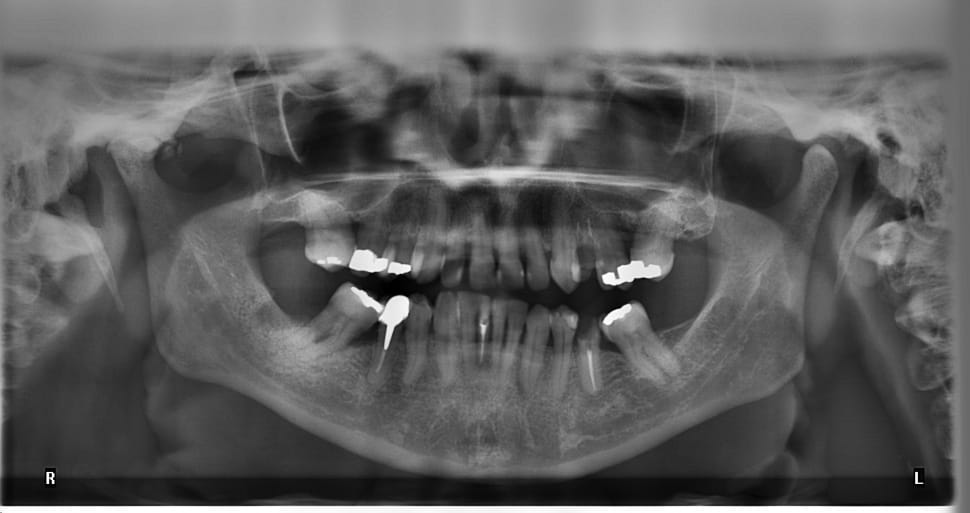 human's teeth x ray preview